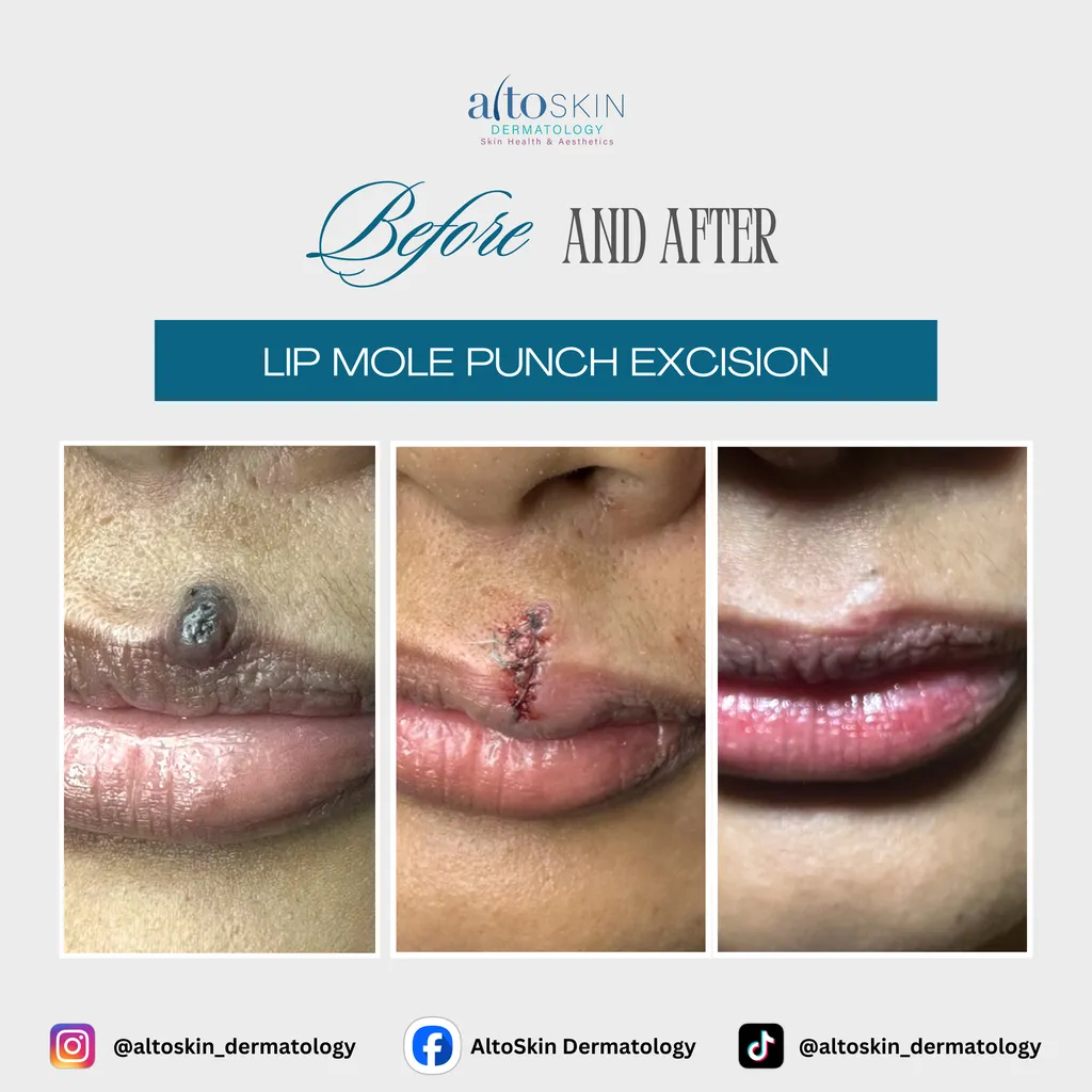 Lip Mole Punch Excision