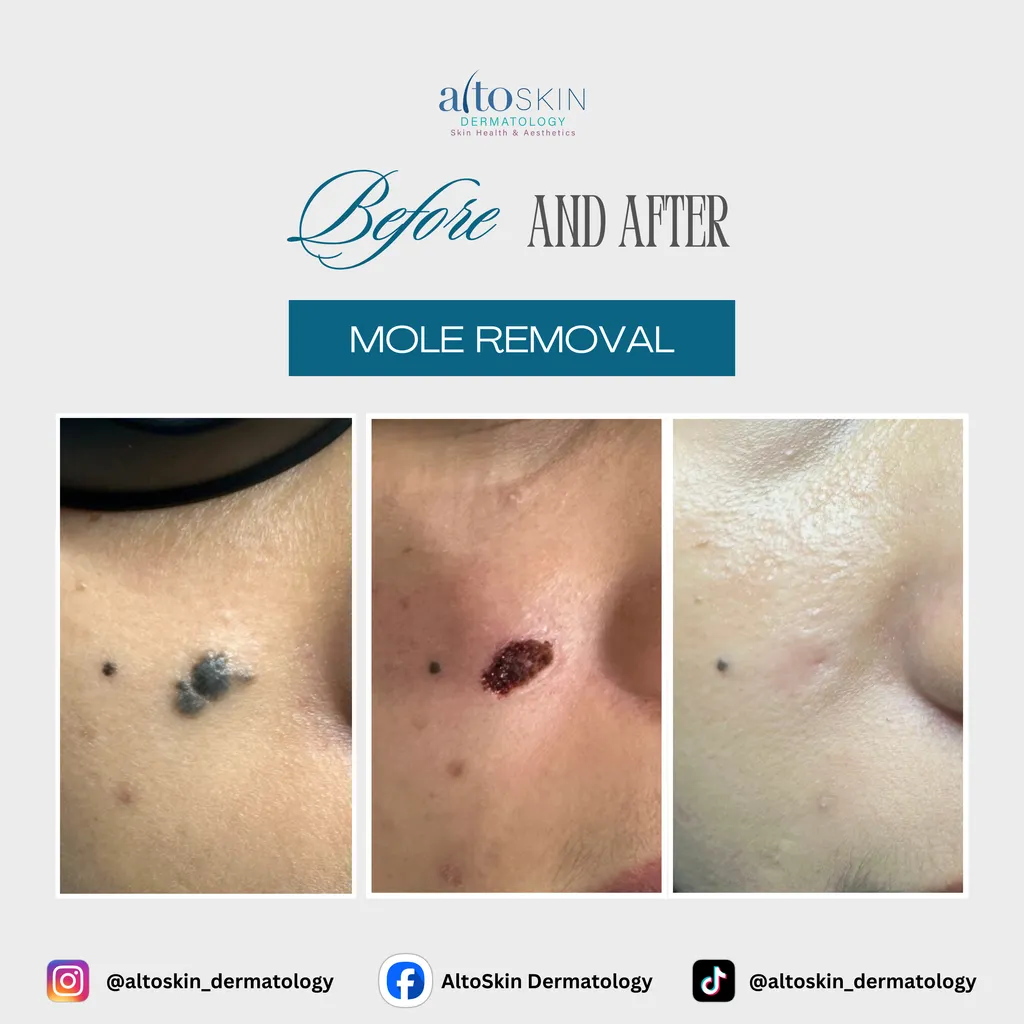Mole Removal