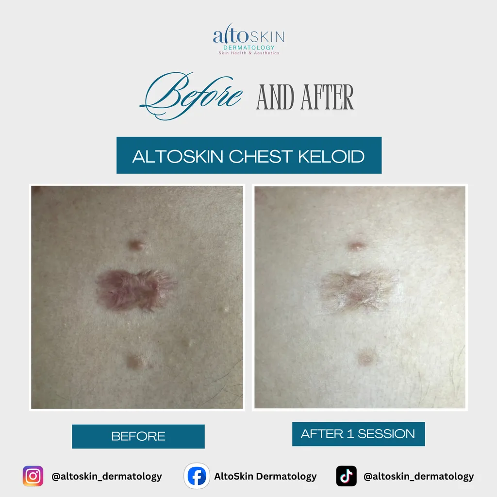 Chest Keloid