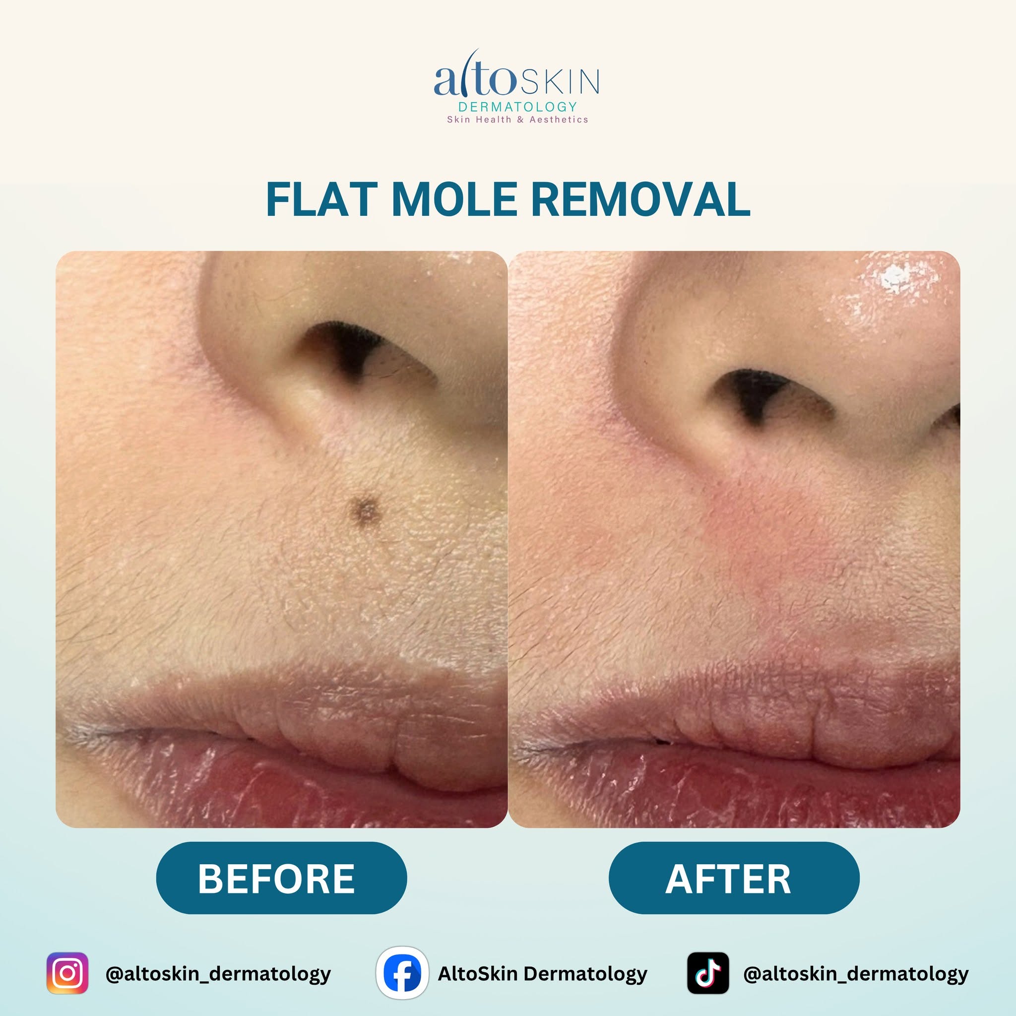 Flat Mole Removal