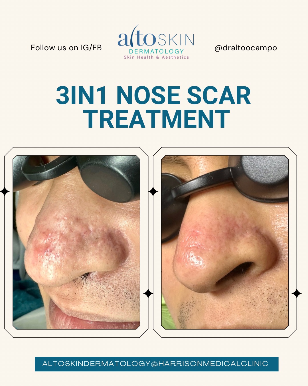 3-in-1 Nose Scar