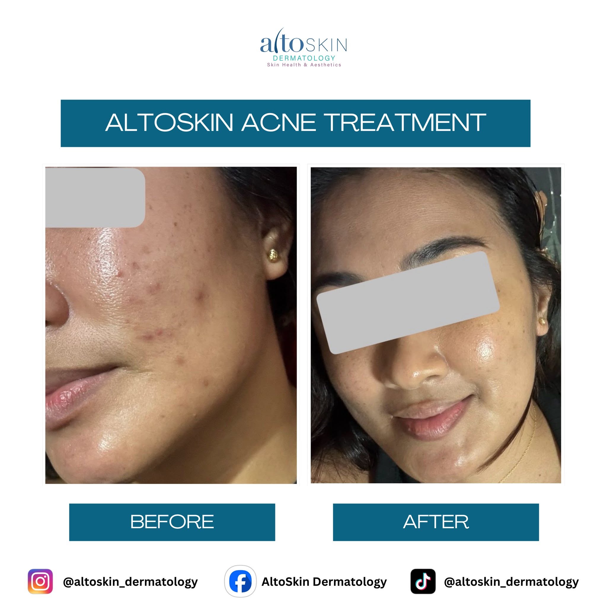 Acne Treatment