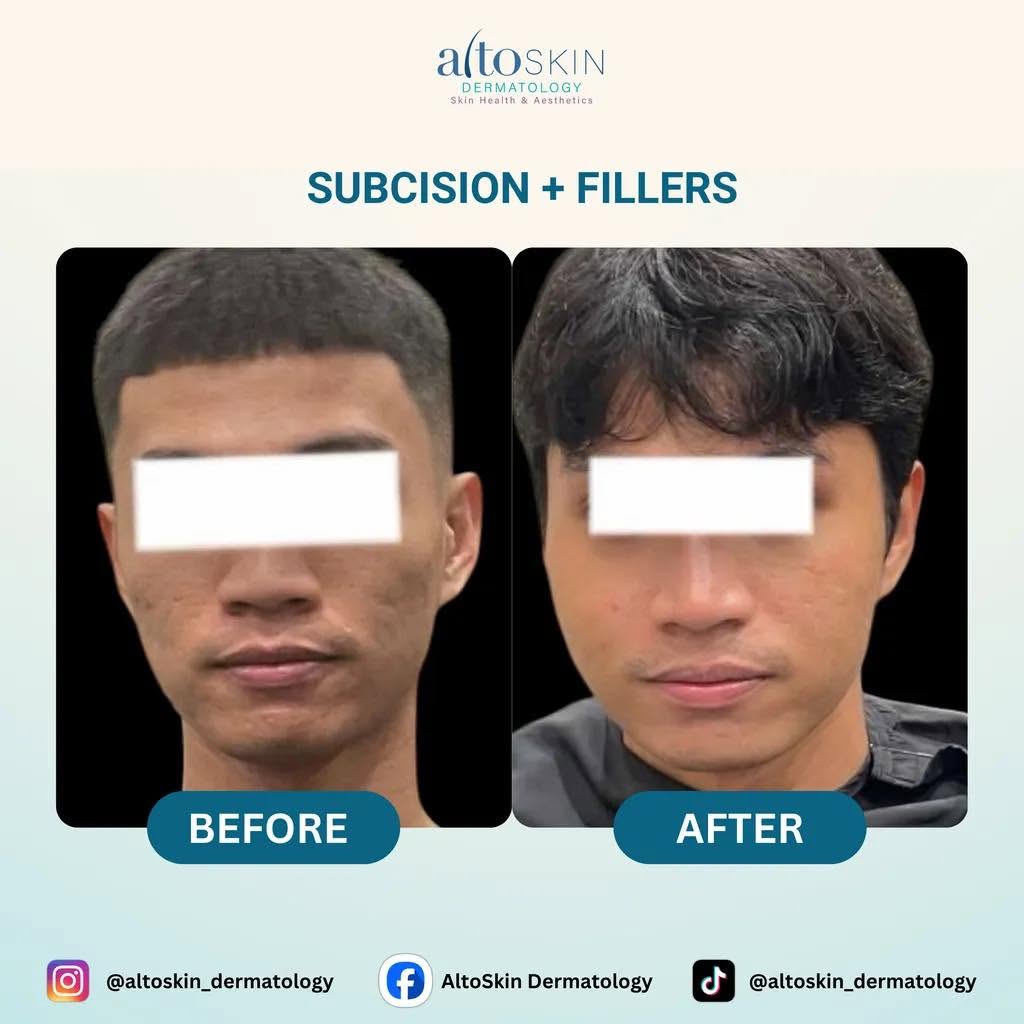 Subcision + Fillers