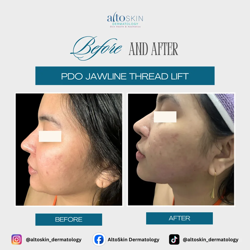 PDO Jawline Thread Lift