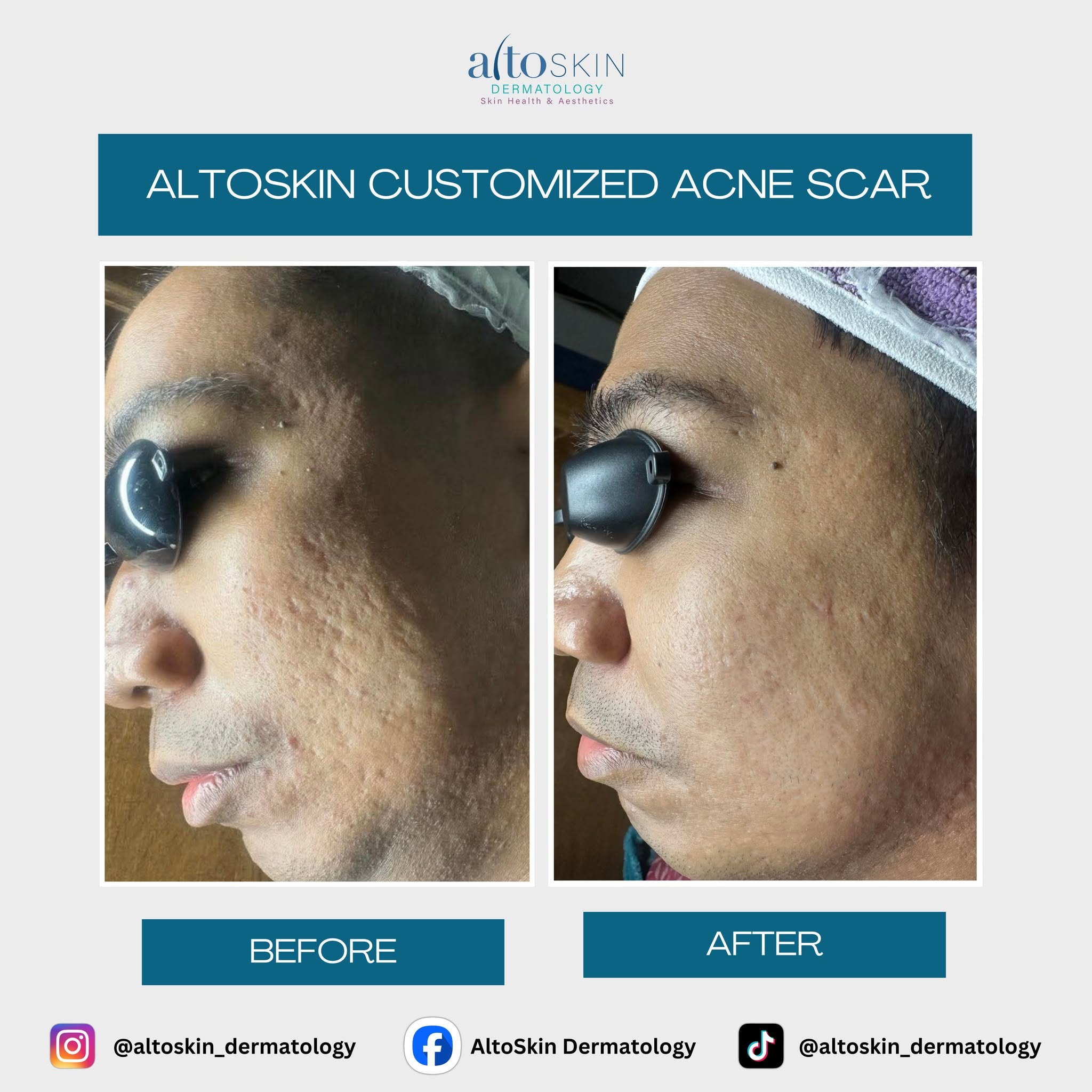 Customized Acne Scar