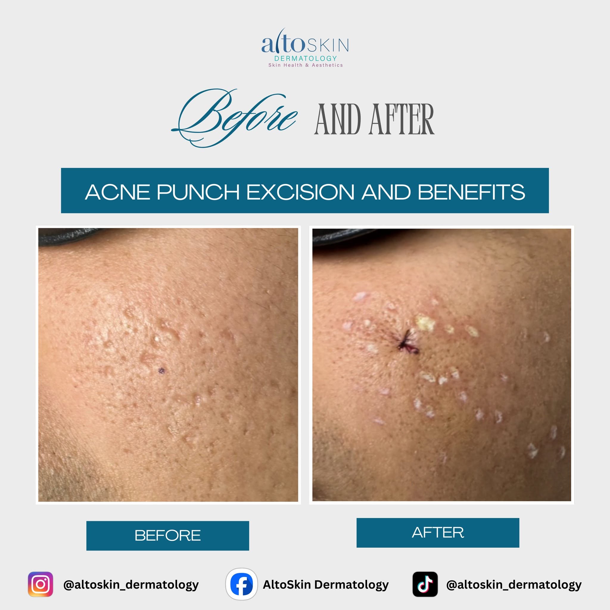 Acne Punch Excision