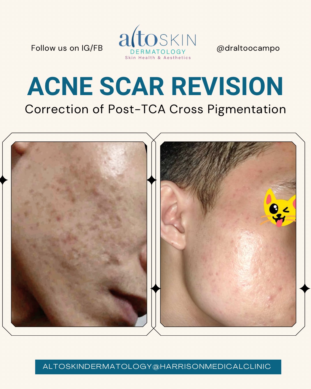 Post-TCA Cross Pigmentation