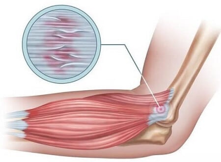 Tennis Elbow ( Epicondylitis )