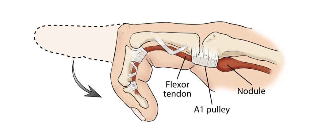 What is Trigger Finger?