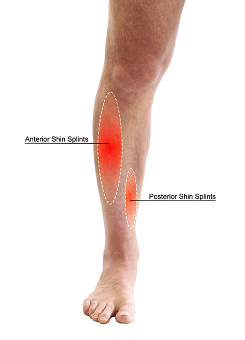 Shin Splints