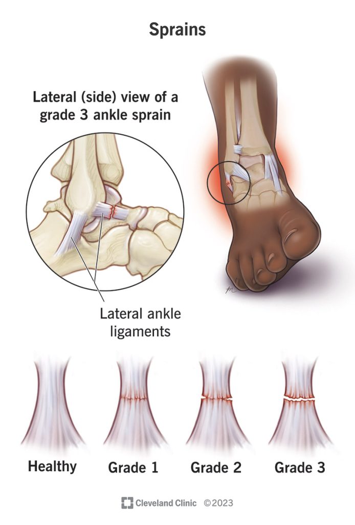 Sprained Ankles