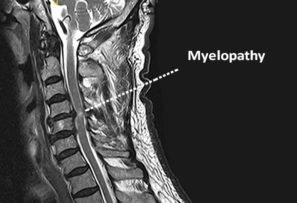Myelopathy