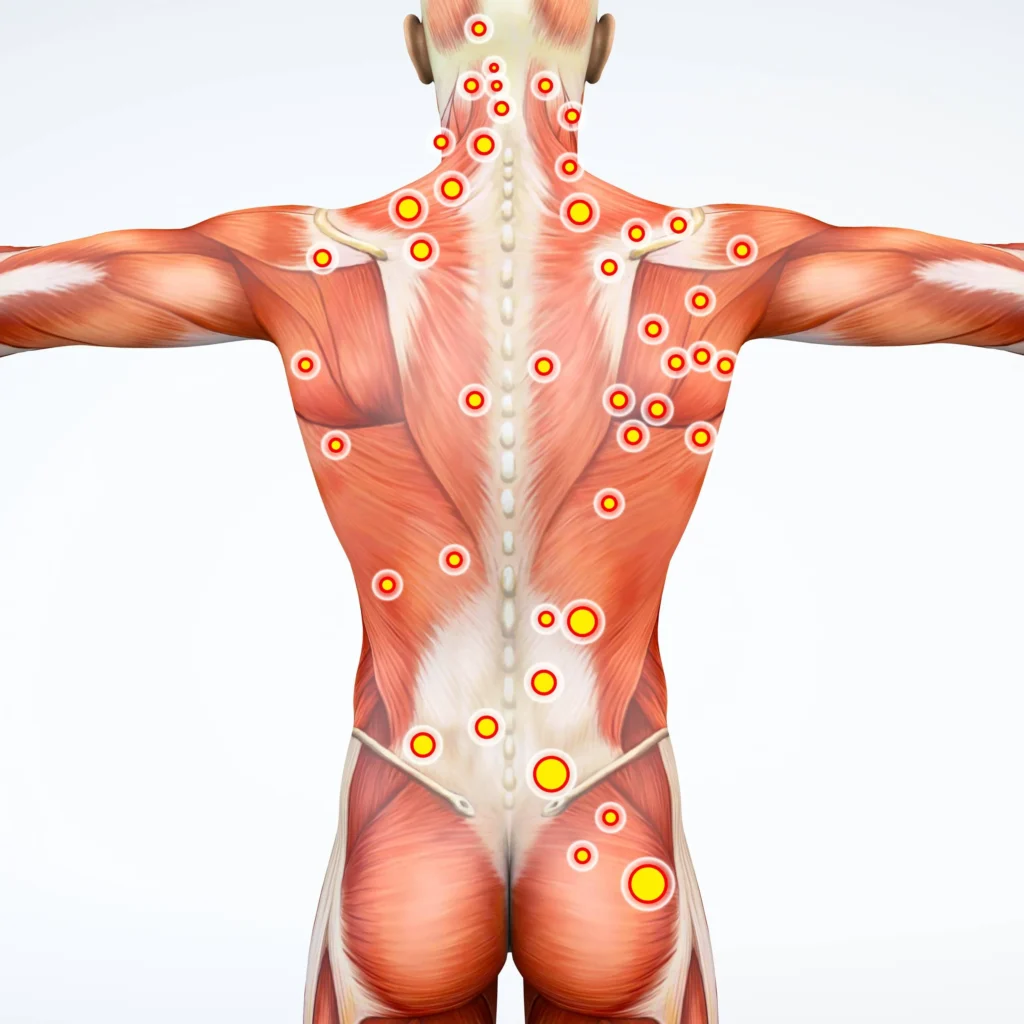 Myofascial Pain Syndrome