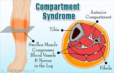 Compartment Syndrome