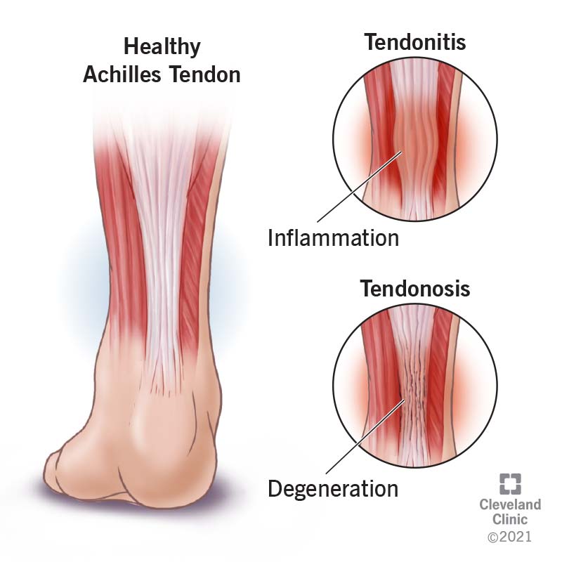 Tendinosis