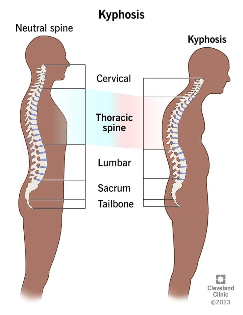 What is Kyphosis?