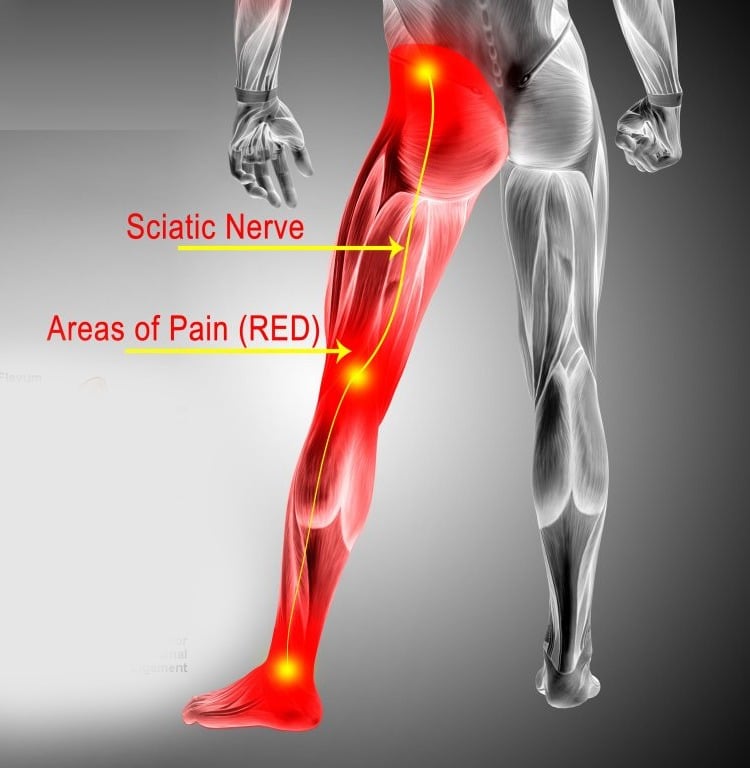 Sciatica