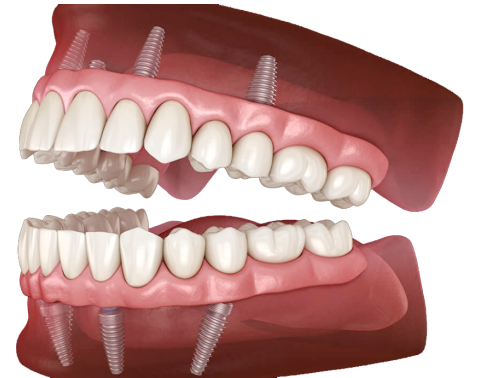 Dental Implant Illustration