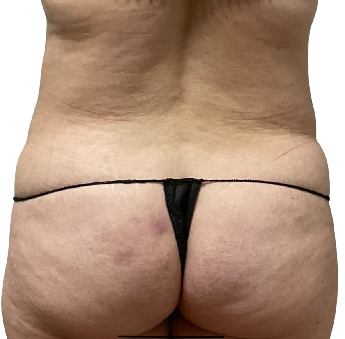 Facial Rejuvenation Result