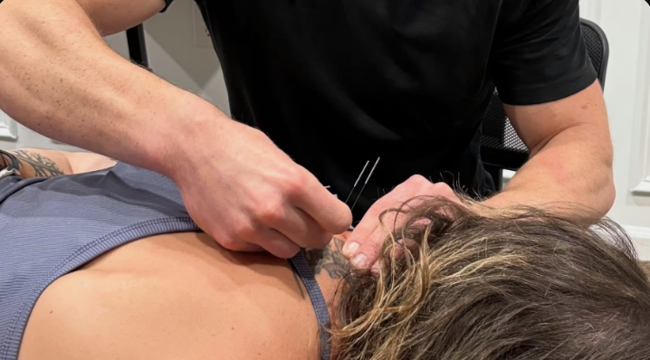Dry Needling