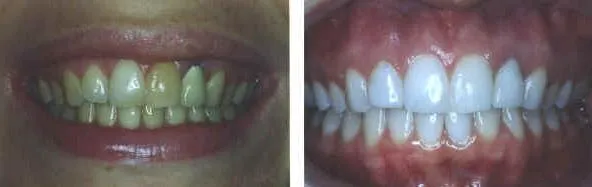 Teeth Whitening Result