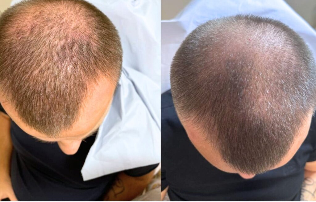 Eye area rejuvenation treatment result Cambridge clinic