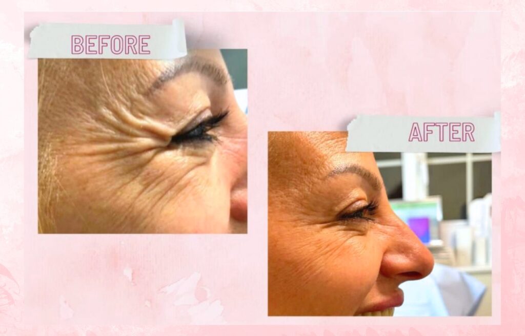Before and after facial aesthetics result at RB Medical Aesthetics Cambridge
