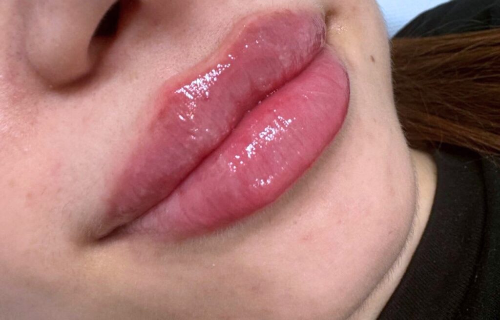 Advanced skin rejuvenation treatment result Cambridge