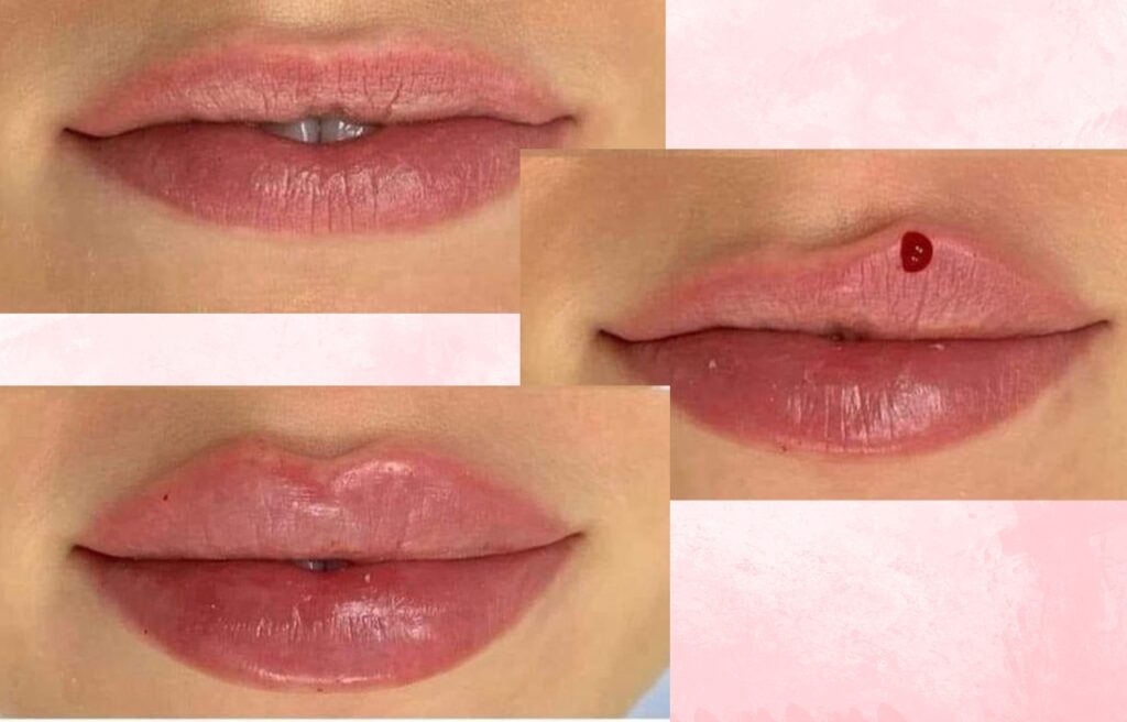 Is Lip Filler Safe? What to Know Before Booking in Cambridge