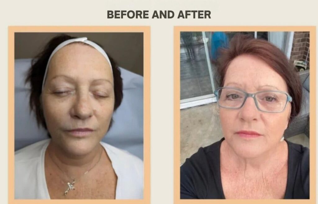 Natural lip filler result at RB Medical Aesthetics