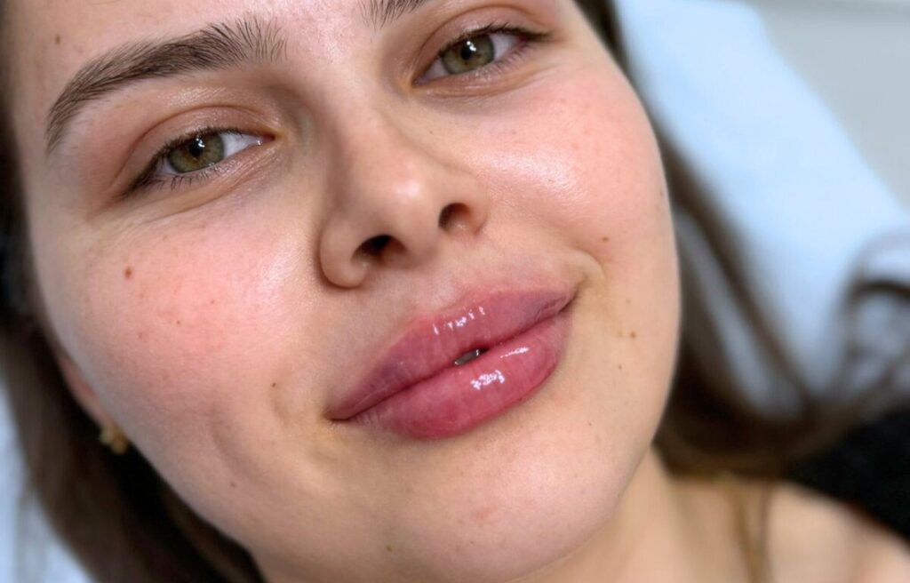 Advanced aesthetic treatment result Cambridge nurse prescriber