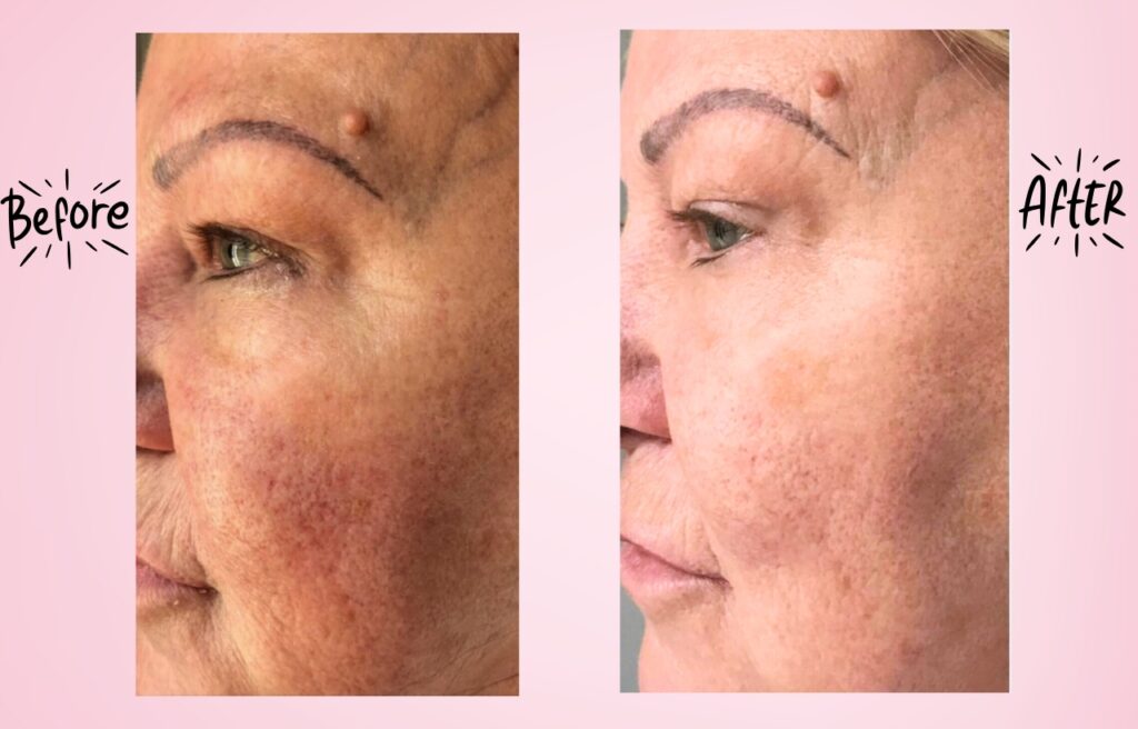 Skin rejuvenation treatment result at RB Medical Aesthetics