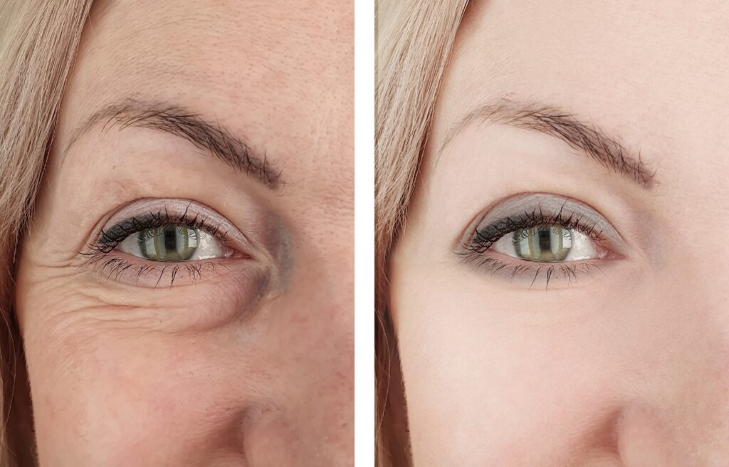 Anti-Wrinkle Treatments: Debunking Common Myths