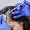 Thinning Hair in Women: Causes, Treatments and When to Seek Help