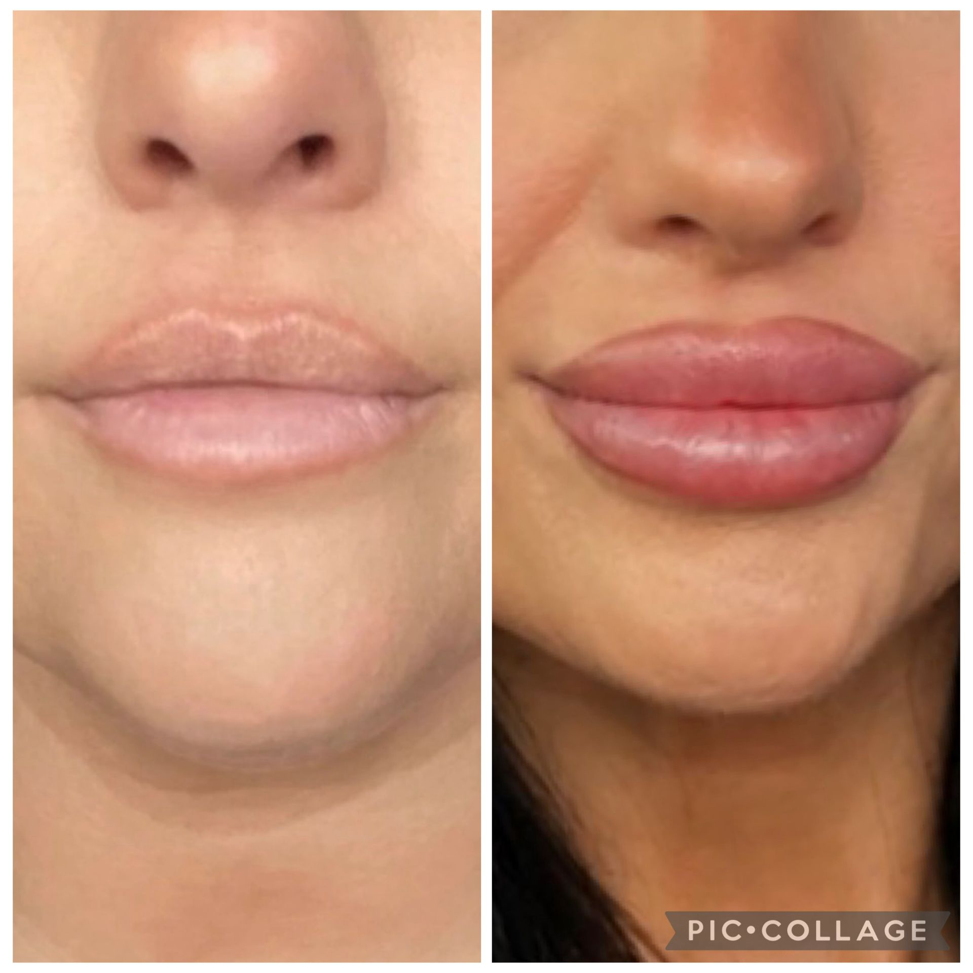 Beautiful Lip Enhancement