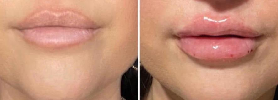 Lip Filler