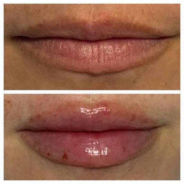 Natural Lip Plump