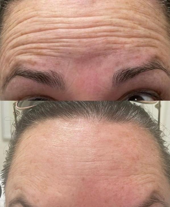Forehead Tox