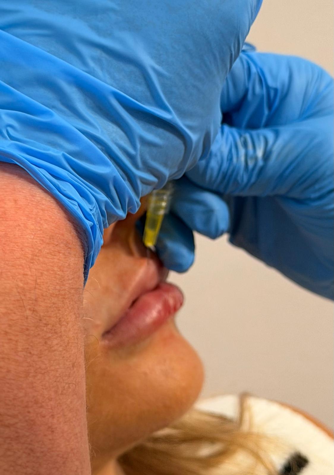 Lip Treatment Process