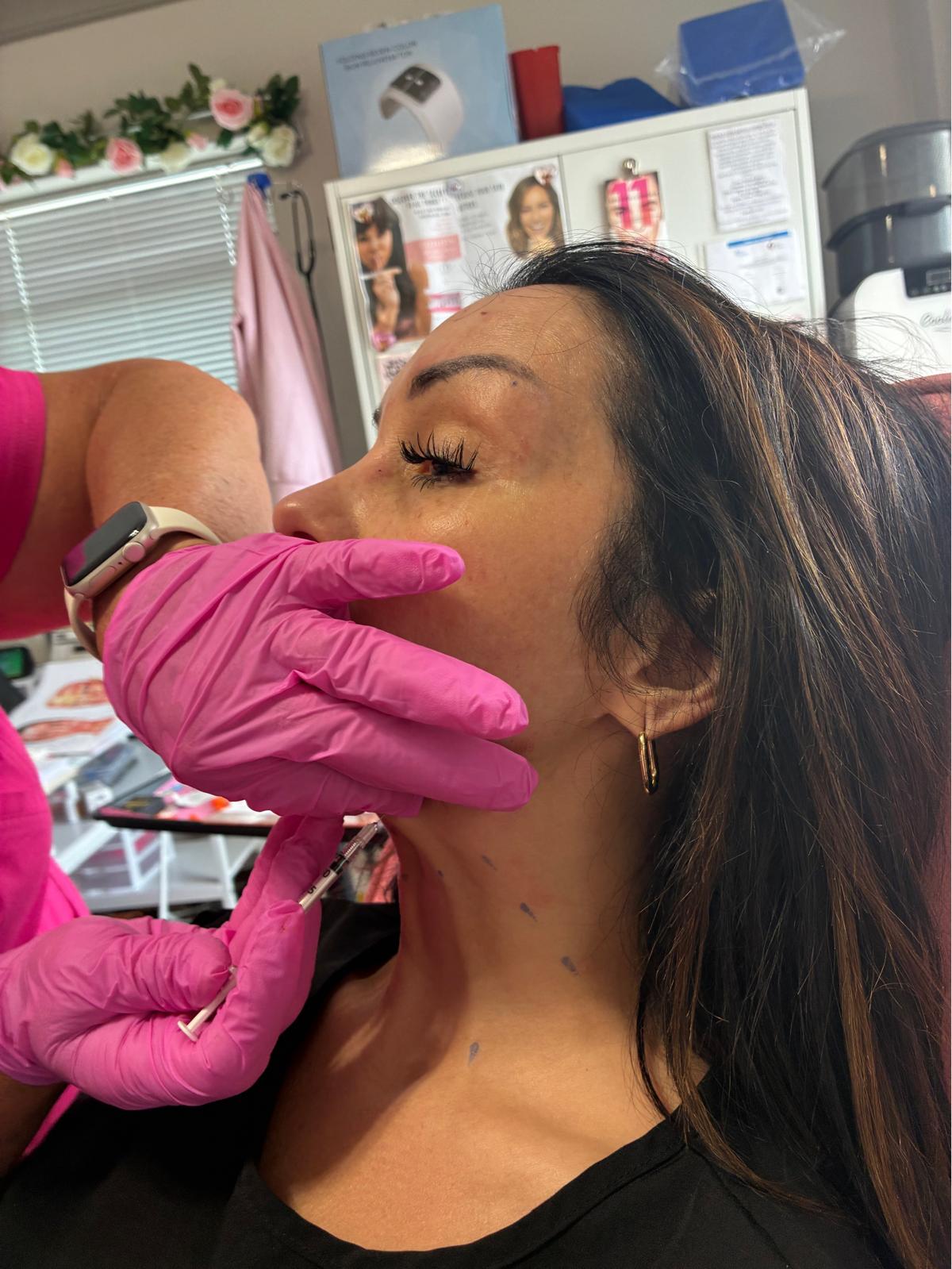 Platysmal Bands Treatment
