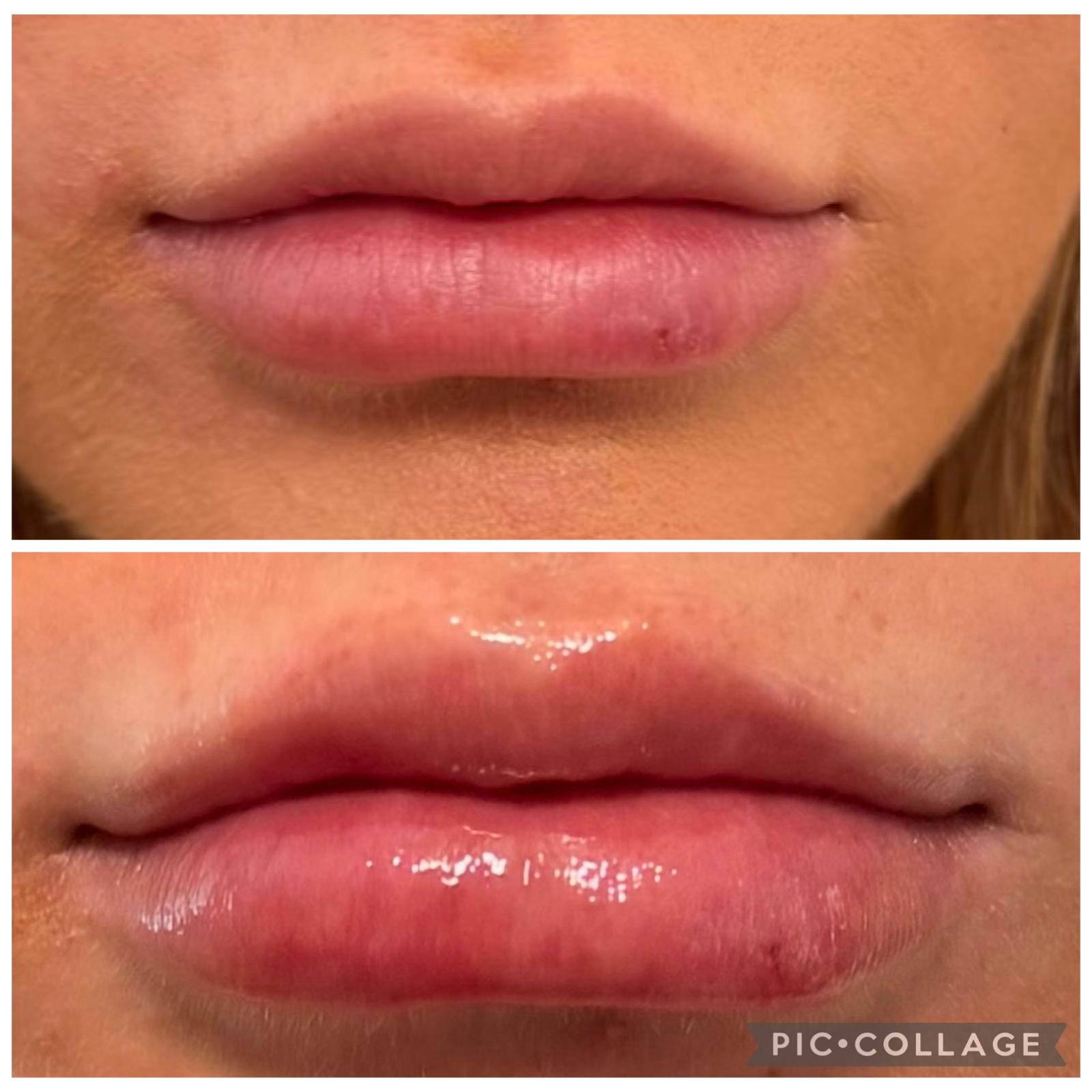Lip Volume Enhancement