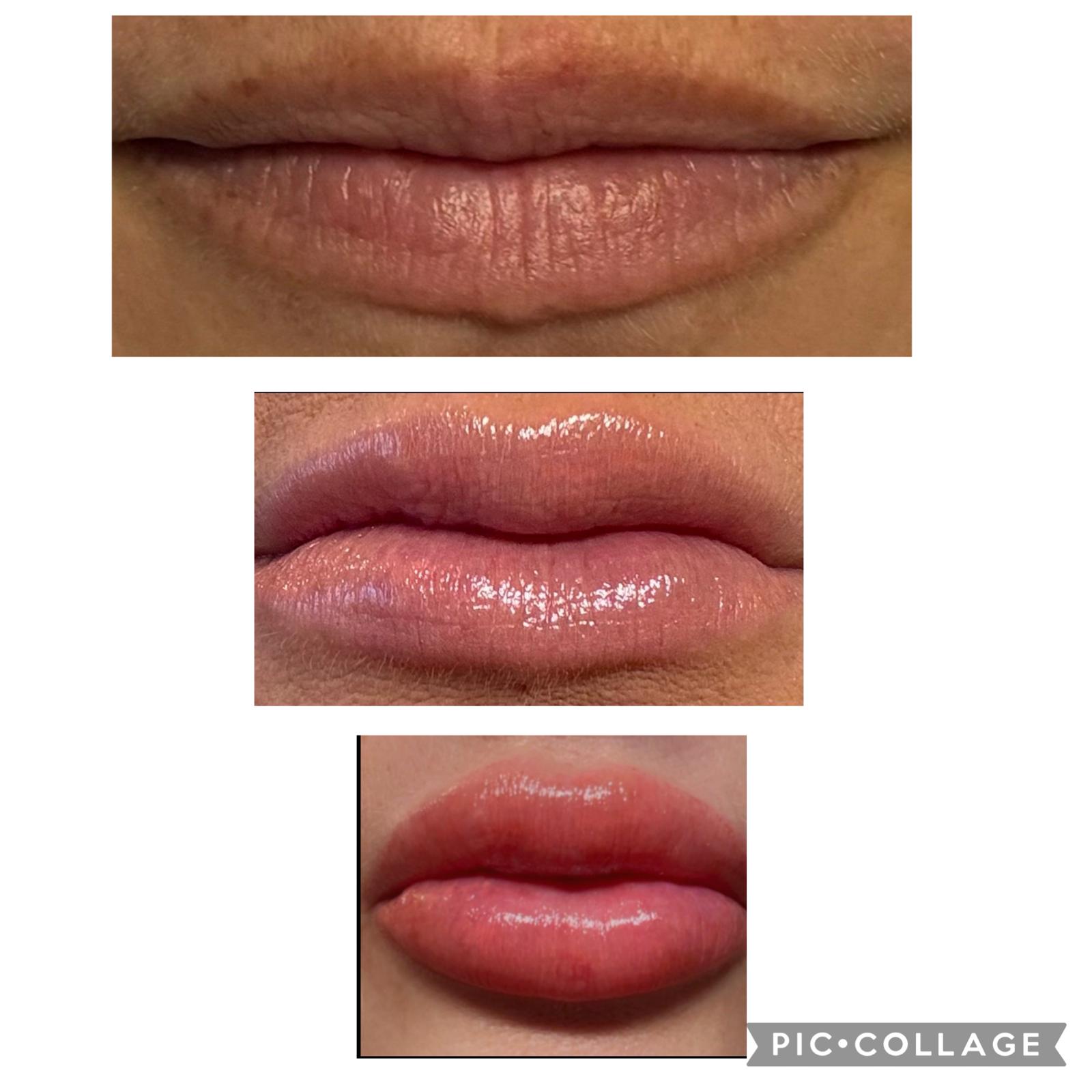 Lip Transformation