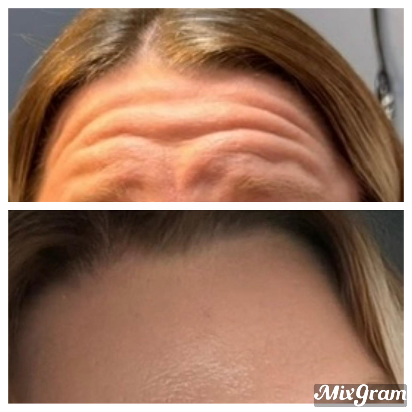 Wrinkle Softening