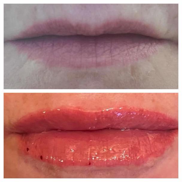 Lip Enhancement