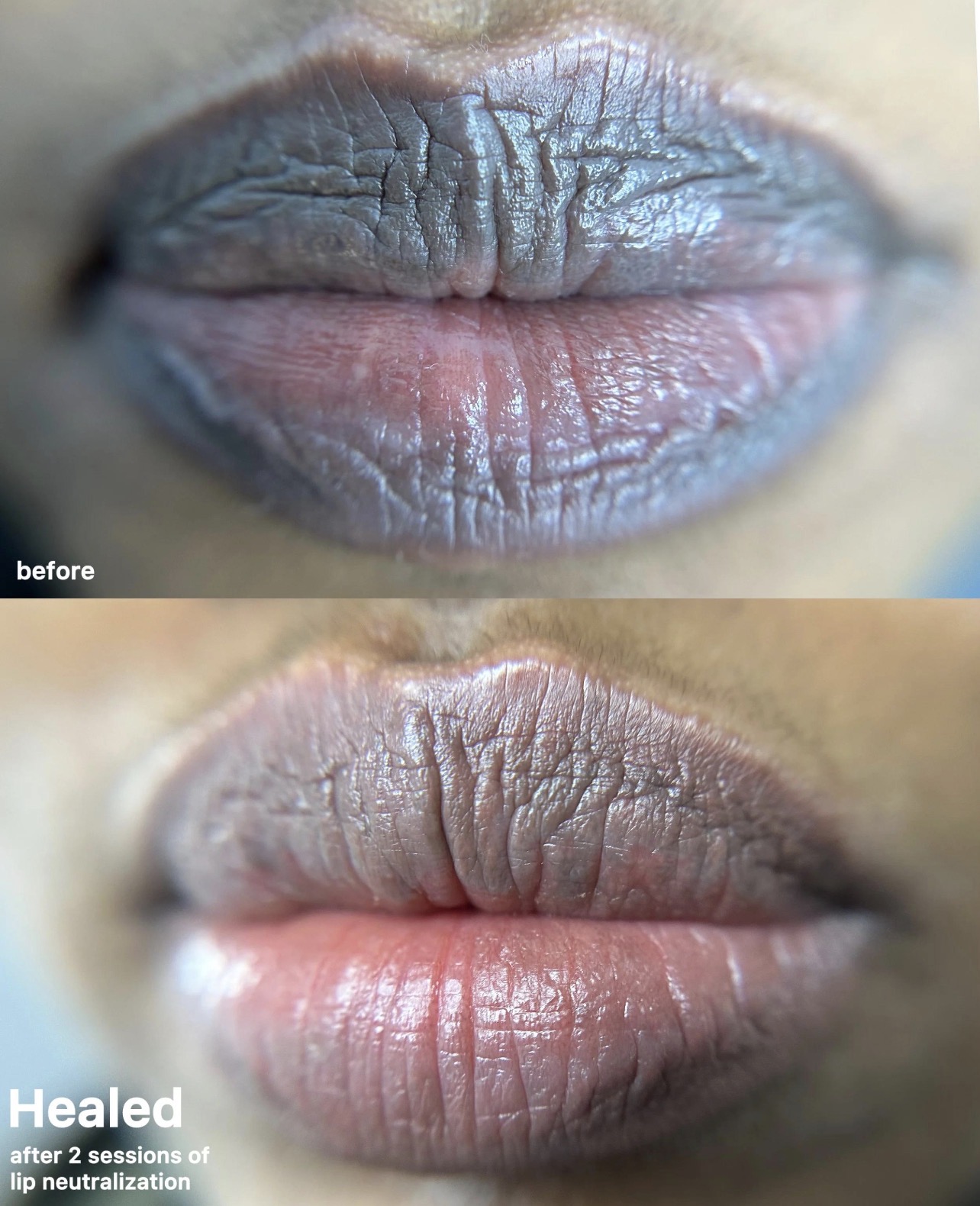 Lip Neutralization Before and After