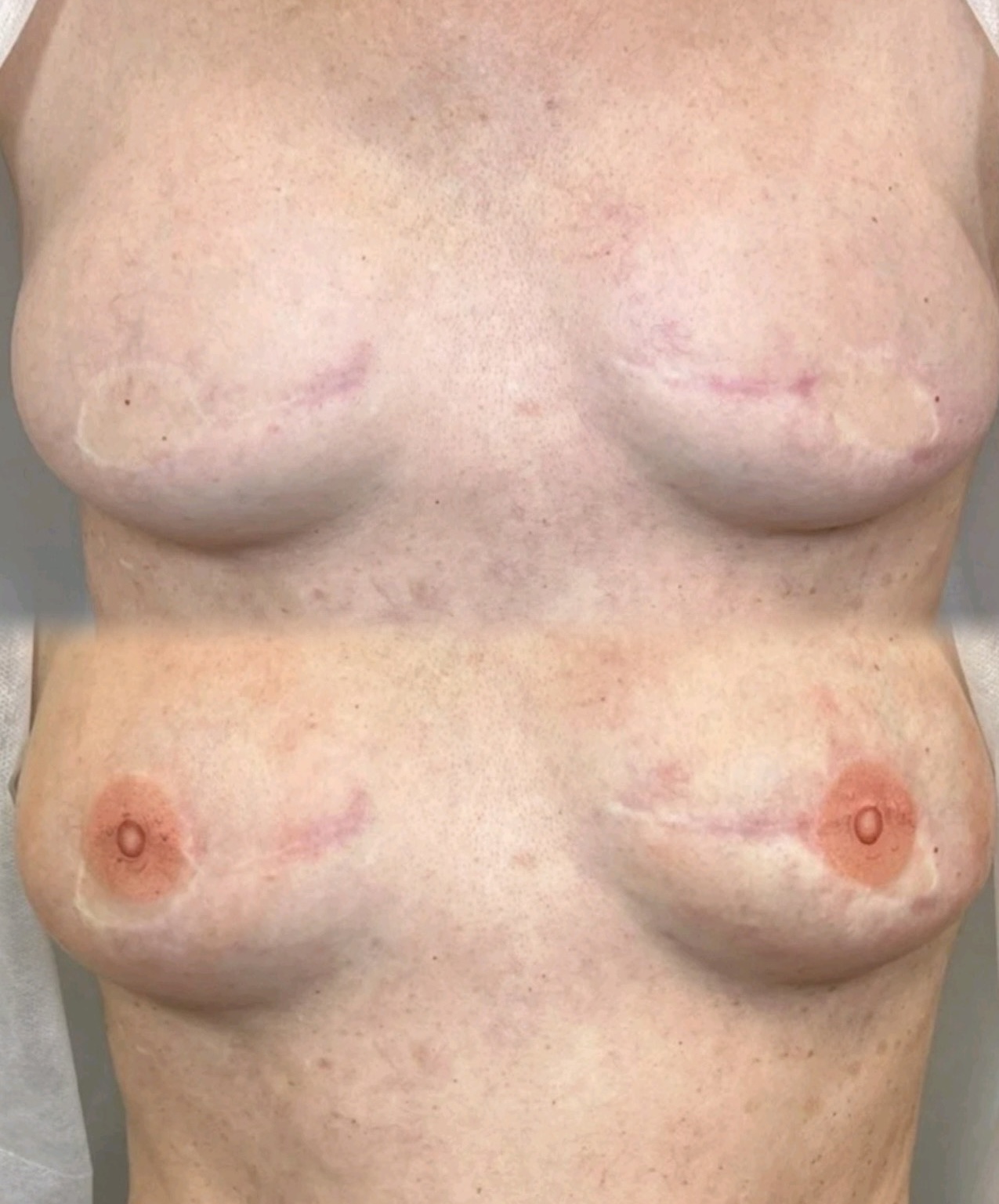 Bilateral Areola Restoration before and after showing beautifully restored 3D areolas