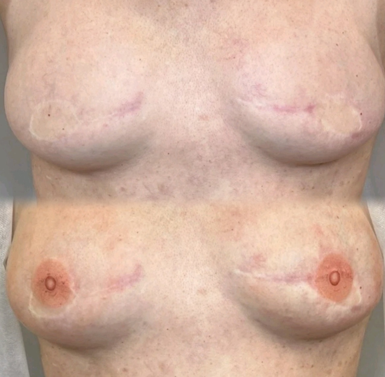 Areola Restoration