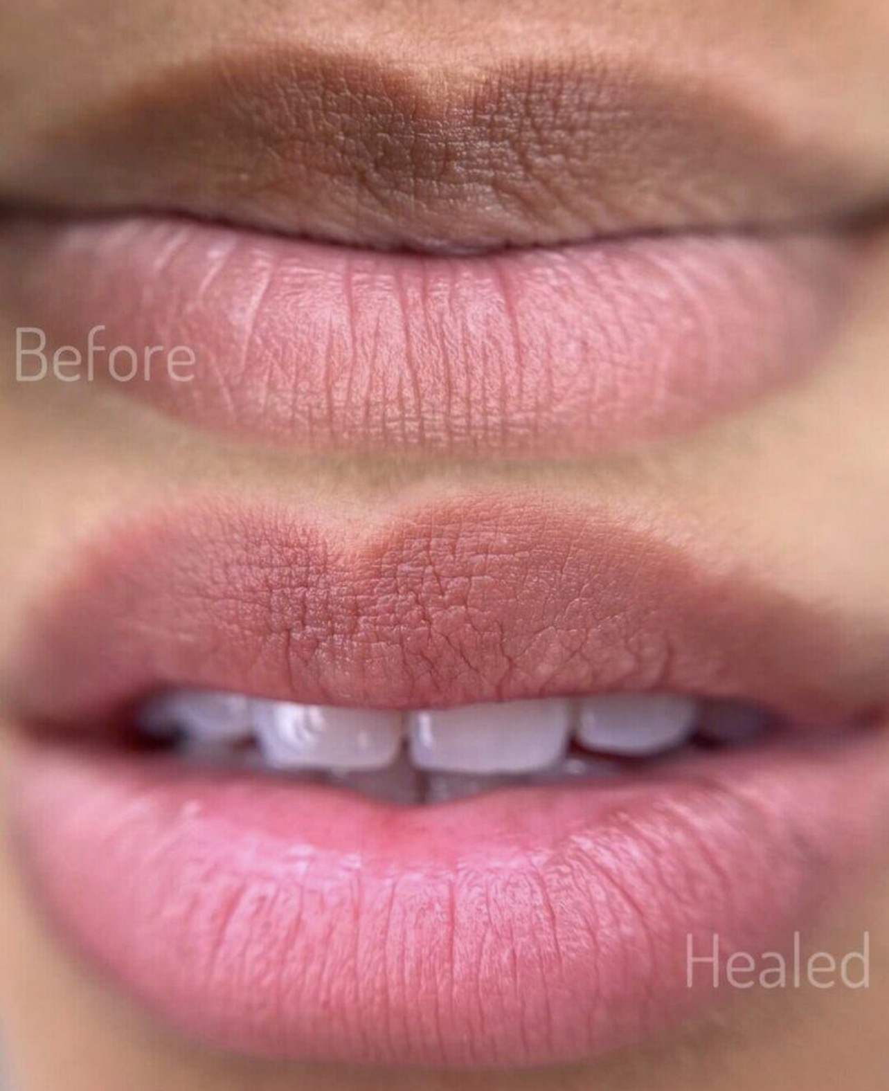 Natural Lip Blush Before and After