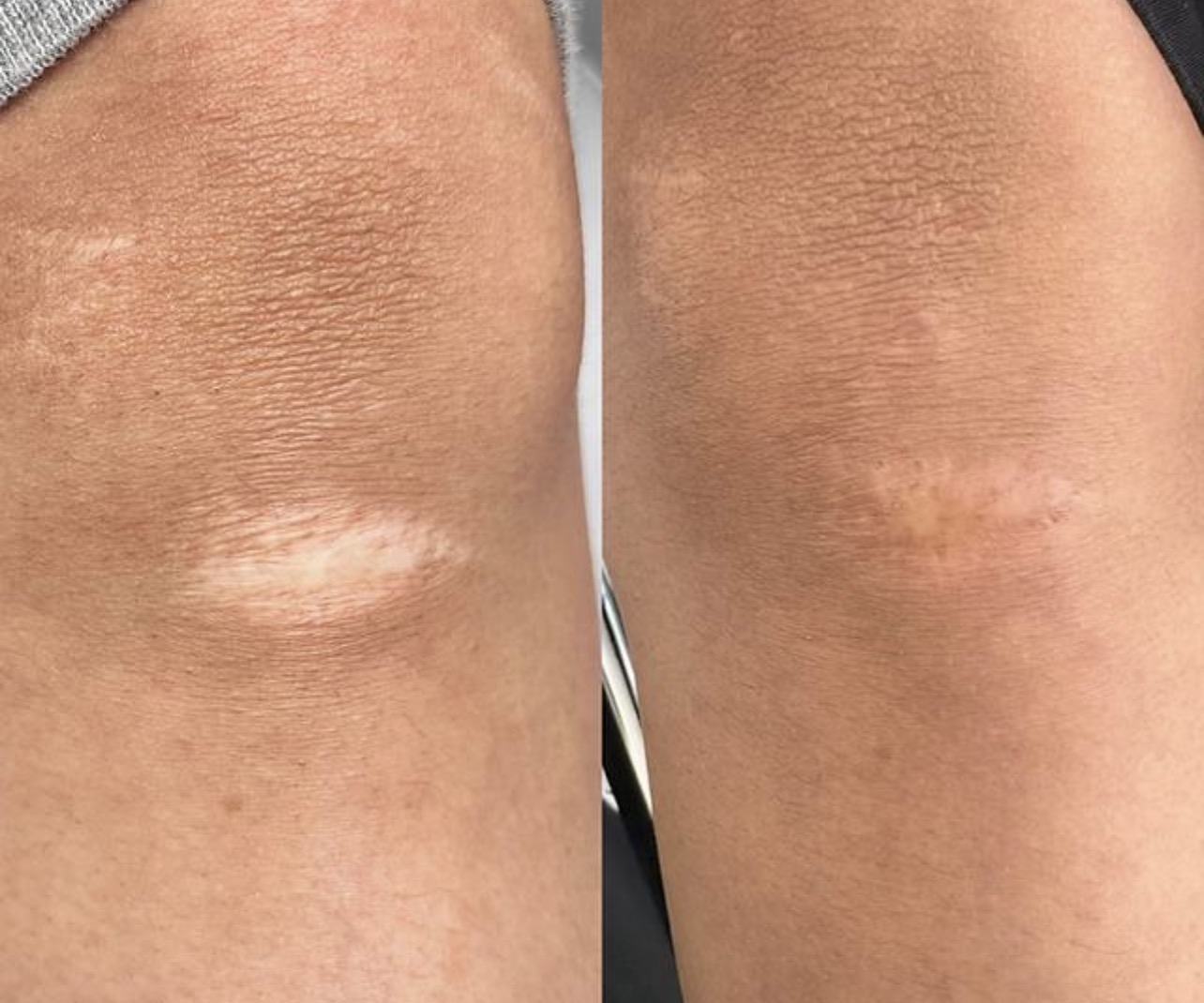 Injury Scar Camouflage showing healed trauma scar with reduced visibility after treatment