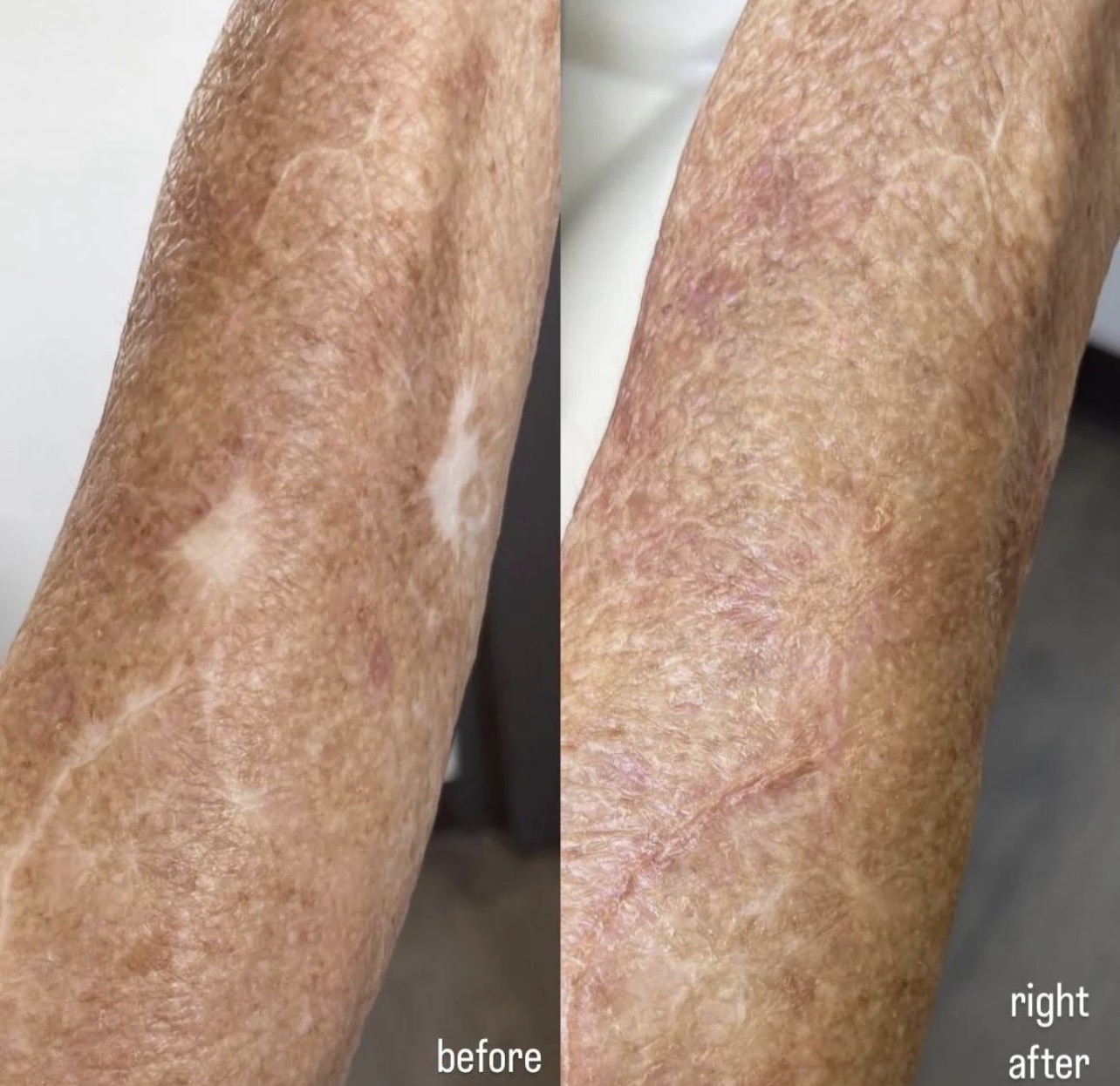Scar camouflage before and after showing beautifully blended healed surgical scar